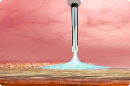 Argonplasma Coagulation