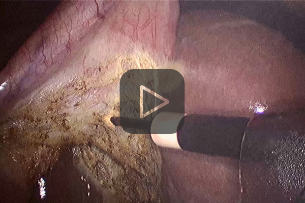 Laparoscopic cholecystectomy with APCapplicator